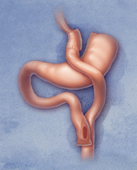 Gastric Bypass